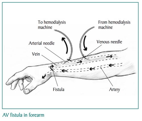 AV Fistula In Forearm